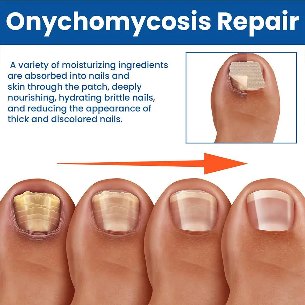 kefuwa Fungal NailRestoration Patches -Restore Clear, HealthyNails Discreetly