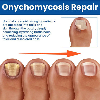 kefuwa Fungal NailRestoration Patches -Restore Clear, HealthyNails Discreetly