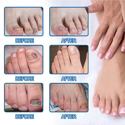 kefuwa Fungal NailRestoration Patches -Restore Clear, HealthyNails Discreetly